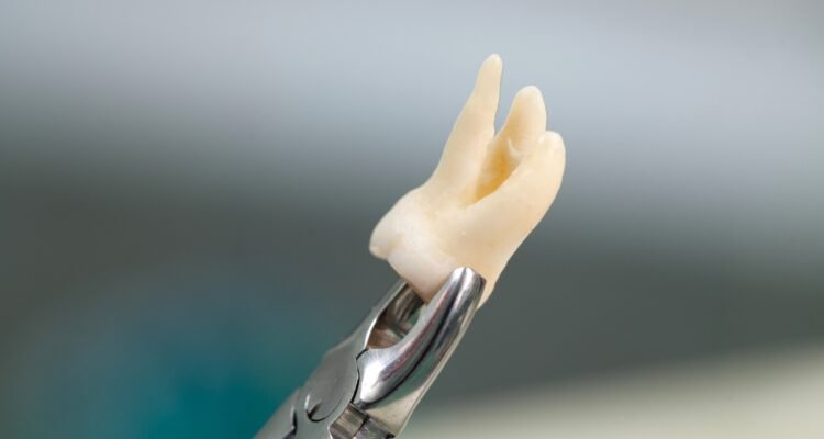Safe & Gentle Tooth Extraction in Lahore