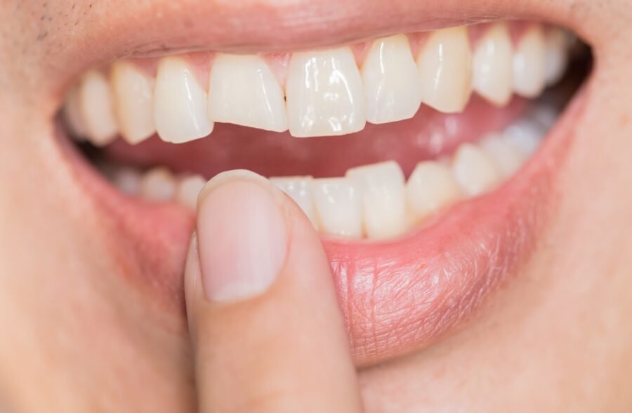 Broken Chipped Tooth Treatment From Aura Dentist Clinic in Lahore