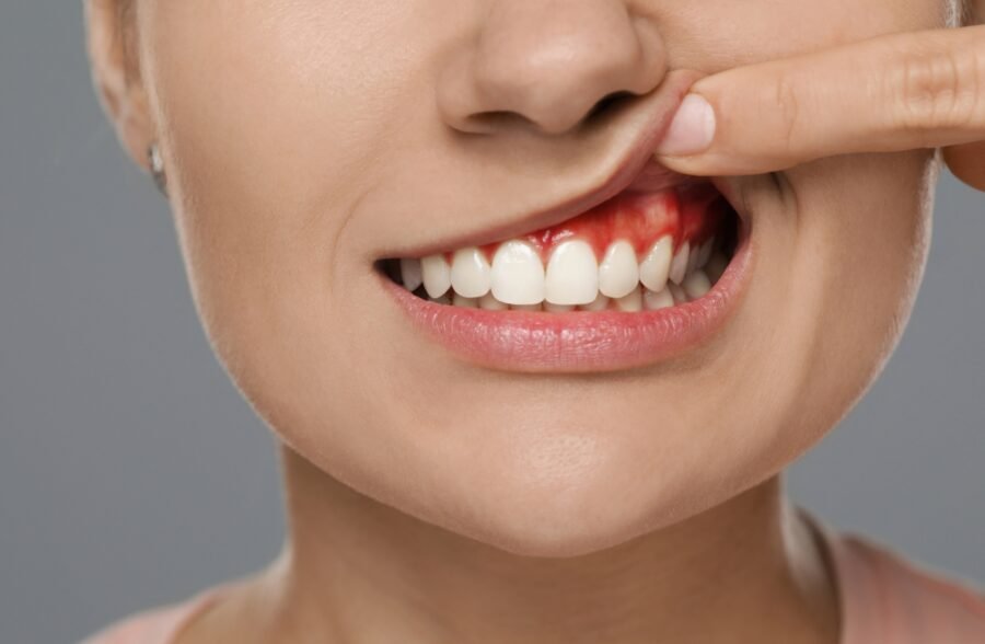 Receding Gums Treatment From Aura Dentist Clinic in Lahore