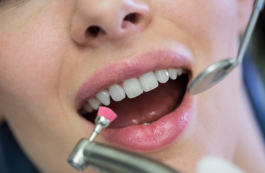 Teeth Cleaning Treatment From Aura Dentist Clinic in Lahore
