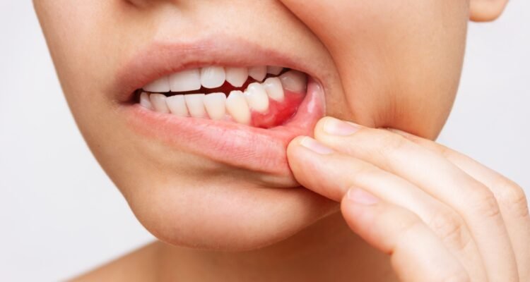 Gum Disease Treatment Services in Lahore
