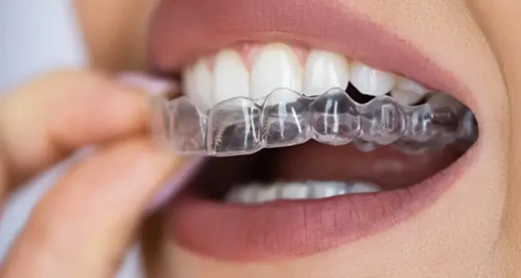 Custom-Made Mouthguards Treatment in Lahore