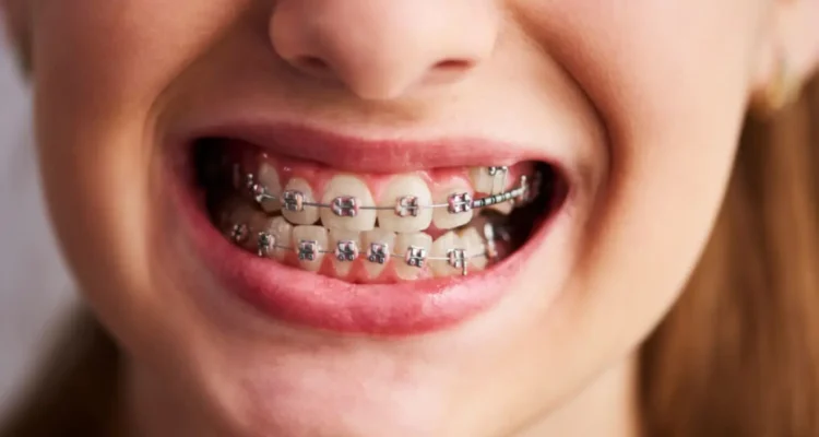 Dental Braces Treatment in Lahore