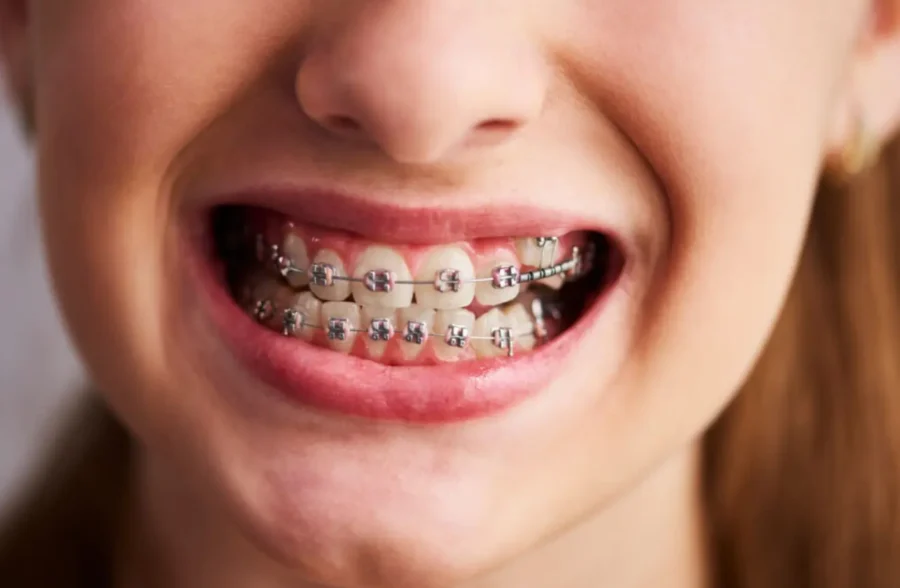 Dental Braces Treatment in Lahore