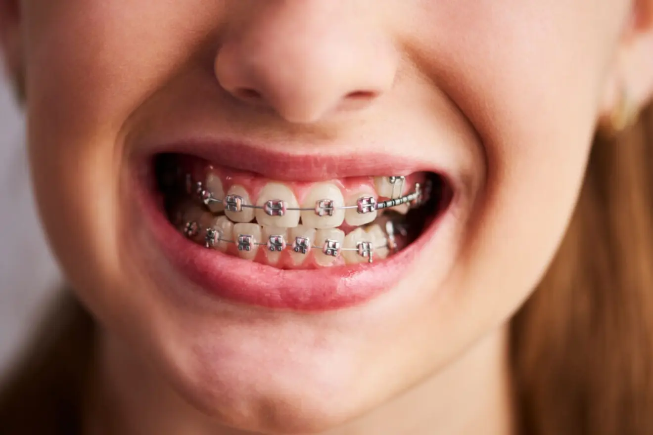 Dental Braces Treatment in Lahore
