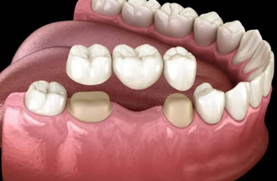 Dental Bridge Treatment in Lahore
