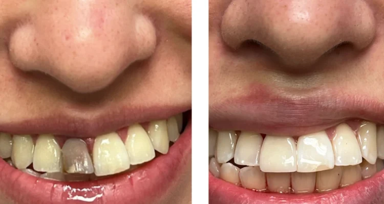 Dental Crowns Treatment in Lahore