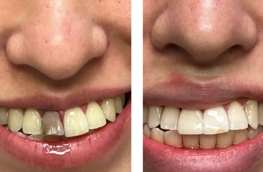 Dental Crowns Treatment in Lahore