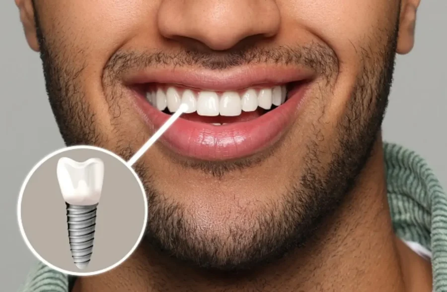 Best Dental Implants in Lahore