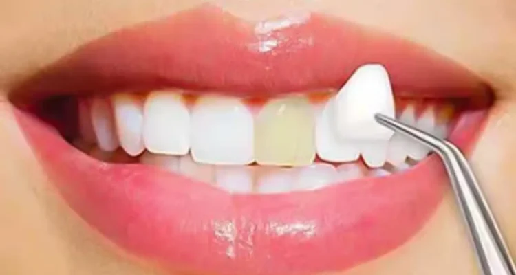 Experts Dental Veneers in Lahore