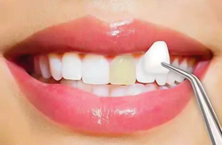dental veneers cost in Pakistan.