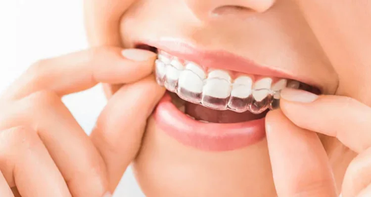 Invisalign Clear Aligners in Lahore