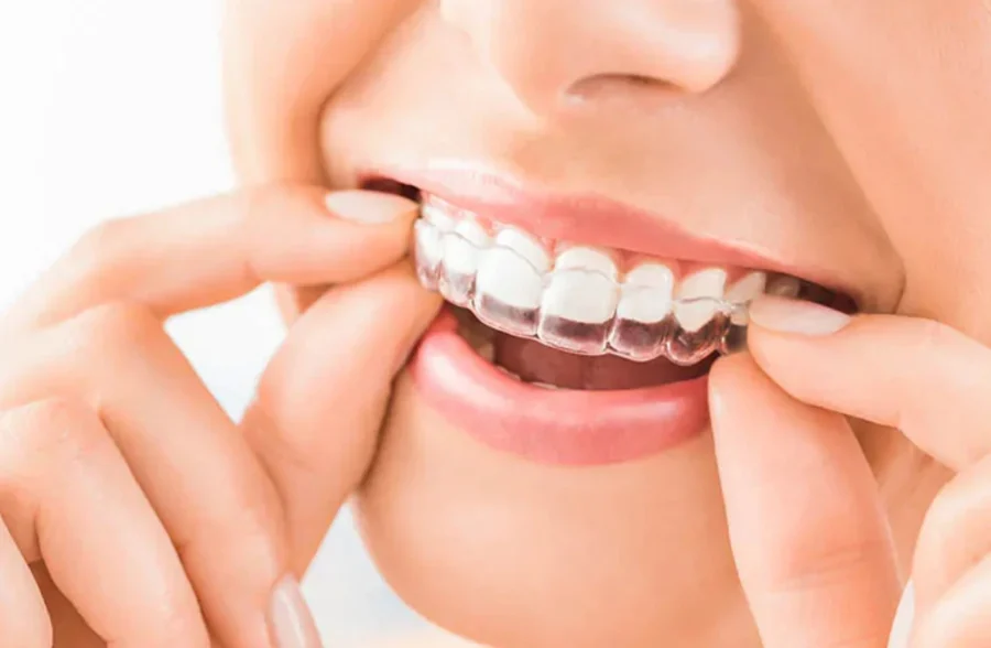Invisalign Clear Aligners in Lahore