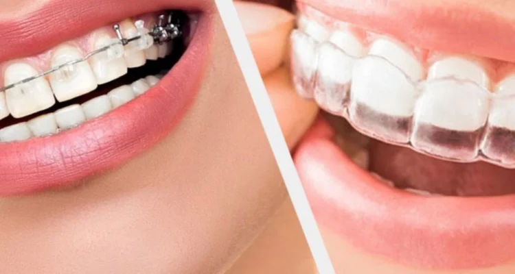 Orthodontic Treatments in Lahore