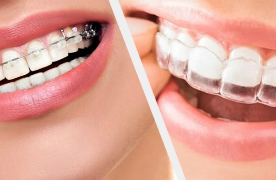 Orthodontic Treatments in Lahore