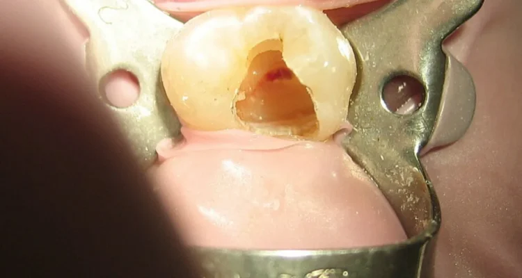 Expert Dentist for Root Canal Treatment in Lahore