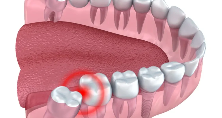 Wisdom Teeth Removal in Lahore