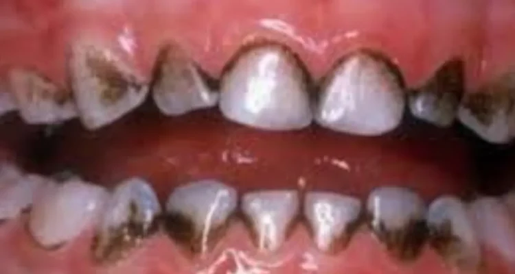 How to Remove Black Stains From Teeth