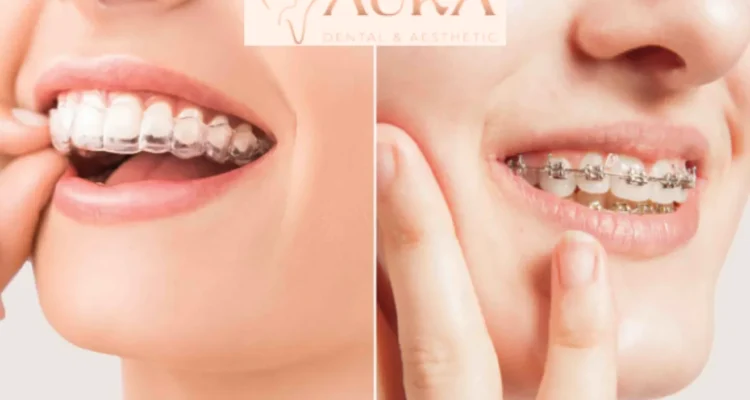 aligners vs braces