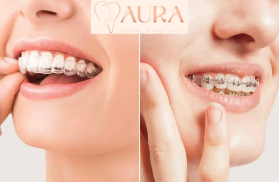 aligners vs braces