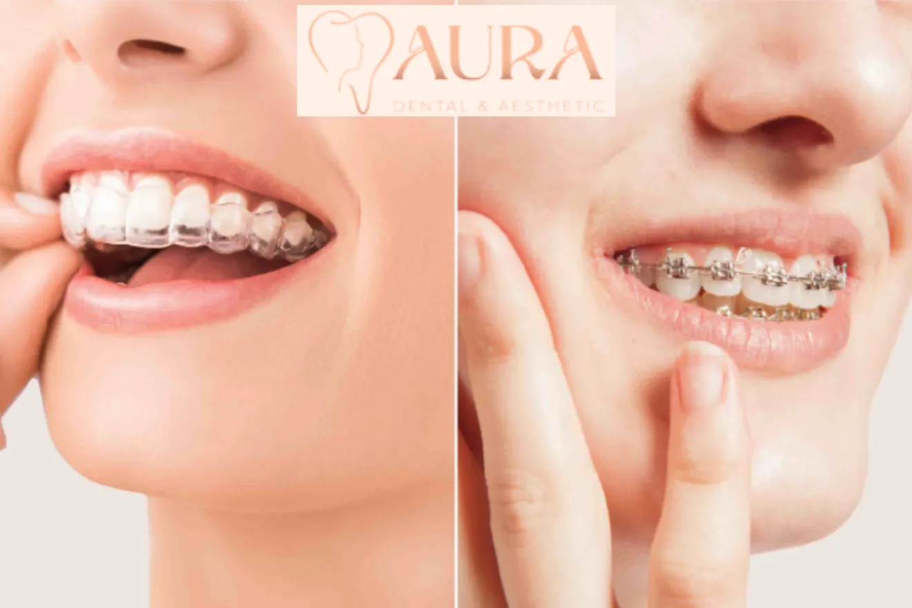 aligners vs braces