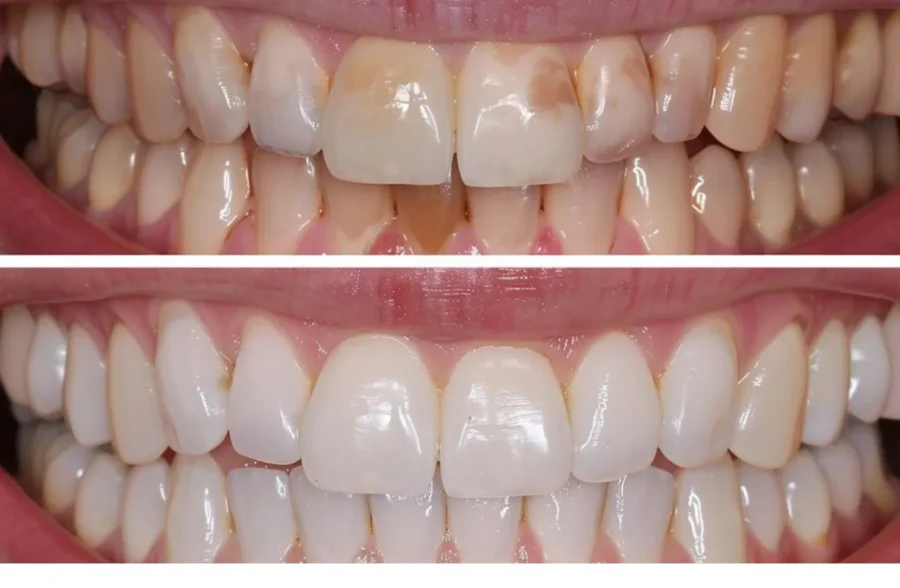 Tooth Discoloration
