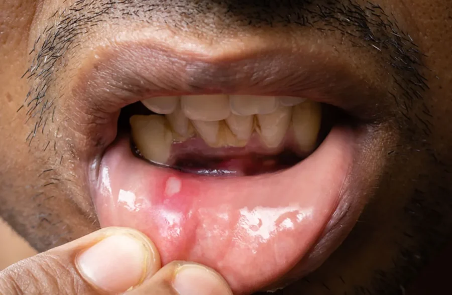 Mouth Ulcers