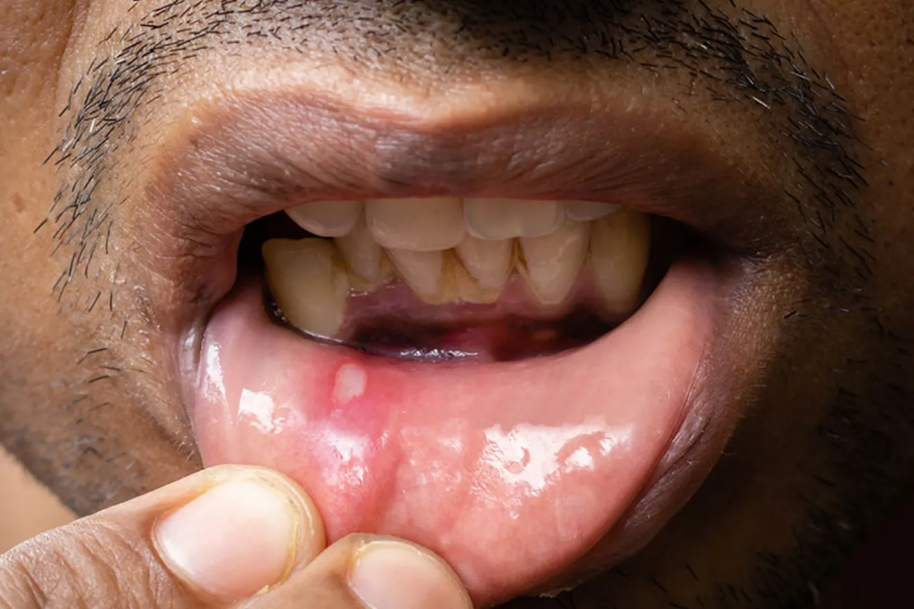 Mouth Ulcers