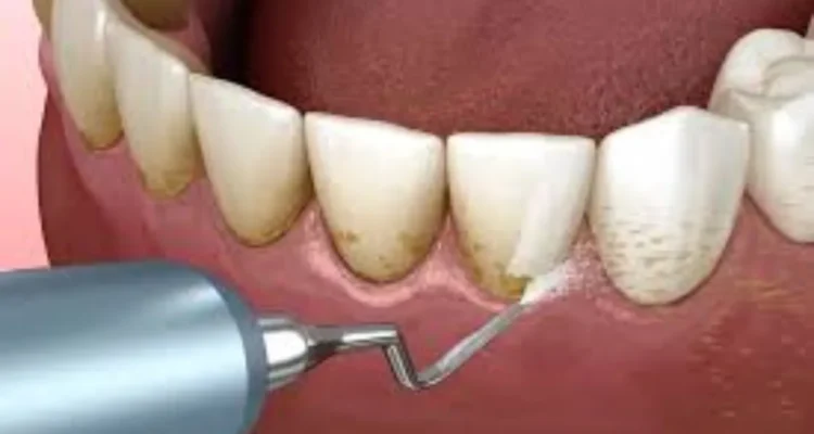 what is teeth scaling?treatment procedure