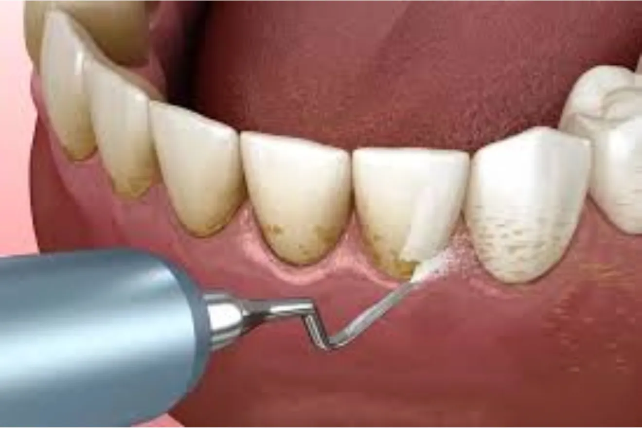 what is teeth scaling?treatment procedure